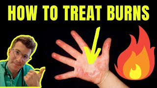 HOW TO TREAT AND MANAGE BURNS AND SCALDS  DOCTOR EXPLAINS plus first aid tips [upl. by Mehelhteb]