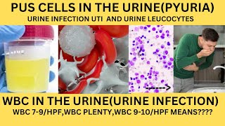 PUS CELLS IN THE URINEPYURIAWBC IN THE URINEURINE LEUCOCYTES CAUSES SYMPTOMS AND TREATMENT [upl. by Akital980]