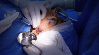 Tmj Arthrocentesis  Joint Pain Relief  Complete Procedure [upl. by Refinnej]