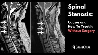 Spinal Stenosis Causes and How to Treat It Without Surgery [upl. by Ahsenauq]