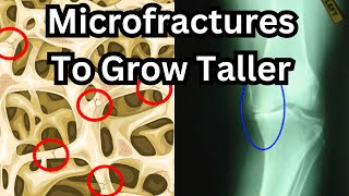 How To Grow Taller After Puberty Full Microfracture Guide with reallife examples [upl. by Atteloiv]