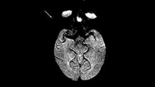 Normal brain perfusion [upl. by Damas]