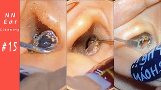 Impacted Ear Wax RemovalEP15  NN Ear cleaning [upl. by Divine]