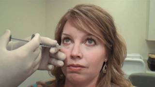 Juvéderm™ Tear Trough Treatment Huntsville Alabama  Dr David L Durst [upl. by Weixel]