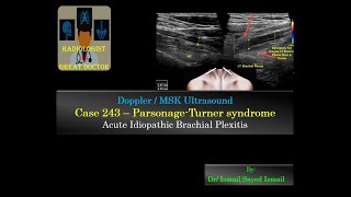 Ultrasound Case 243  Parsonage Turner Syndrome [upl. by Goodkin]