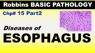 Chp15 Part2 Robbins Basic Patho  Diseases of ESOPHAGUS  Dr Asif Lectures [upl. by Ynagoham]