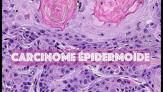 LE CARCINOME EPIDERMOÏDE CUTANE  PATHOLOGIE [upl. by Caplan452]