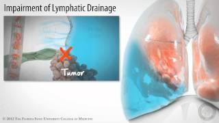 Pleural Space Part 3 of 3 Pleural Effusions HD [upl. by Penney134]