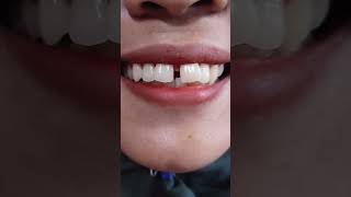 Diastema Closure  Dokter Gigi  Cuspaeni dentalcare dentist veneers trending foryou tiktok [upl. by Ateuqram]