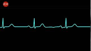 PEA  Pulseless electrical activity [upl. by Assirek]