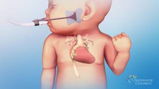 Hypoplastic Left Heart Syndrome HLHS Hybrid Stage One Procedure [upl. by Sesilu]