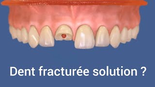 Dent fracturée solution  réparation dent cassée devant par la résine composite [upl. by Imalda581]