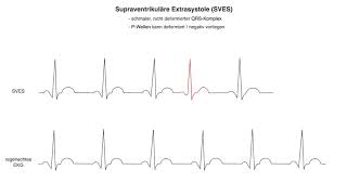 Supraventrikuläre Extrasystole SVES wwwclipdocsde [upl. by Misty]