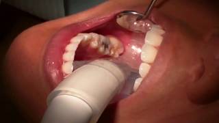 Minimally Invasive Cavity Treatment [upl. by Anwad604]