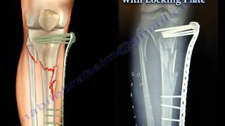 External Fixation With Locking Plate  Everything You Need To Know  Dr Nabil Ebraheim [upl. by Ahsinet]