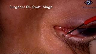 Punctal cautery by Dr Swati Singh L J Eye Institute [upl. by Rap]