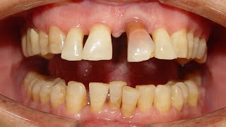 Severe Median Diastema due to Pathological drifting of Upper front teeth [upl. by Sacksen684]