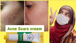 Review Of Acnes Scar Care Gel  How To Use  Medicated Acne Scar Treatment [upl. by Trevah131]