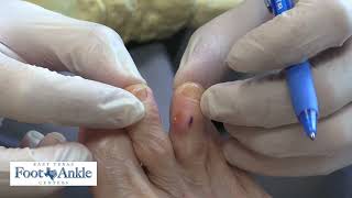 How to use a slippo pad for a hammertoe [upl. by Nahgeem390]