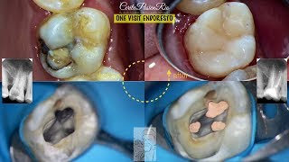 endodontic treatment continuous wave obturation warm lateral palfique super low [upl. by Dunning]