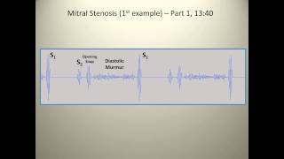 Examples of mitral stenosis murmurs [upl. by Laerdna]