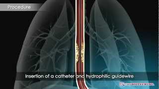 SampG BiotechEGIS Esophageal Stent [upl. by Acinomahs]