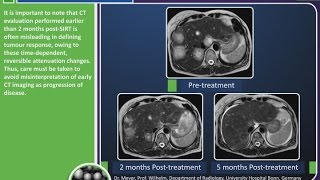 Post Treatment Imaging for SIRSpheres Y90 resin microspheres [upl. by Filippo]