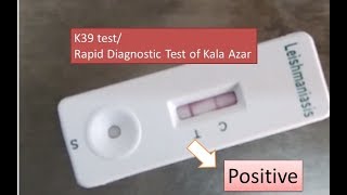 K39 test poaitive  Kala Azar Leishmaniasis  Visceral Leishmaniasis RDT k39 test Rapid test [upl. by Levitan422]