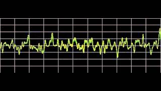 Cluster Headaches  Rife Frequencies [upl. by Timothea]