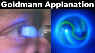 Goldmann Applanation Tonometry Procedure Technique Tutorial [upl. by Alliscirp]