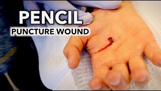 HE STABBED HIS HAND WITH A PENCIL puncture wound  Dr Paul [upl. by Etnovaj]