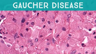 Gaucher disease involving bone lysosomal storage disorder glucocerebrosidase deficiency pathology [upl. by Ahsil]