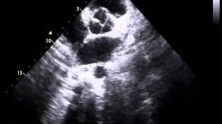 quadricuspid aortic valve and perimembranous ventricular septal defect [upl. by Ymrots774]