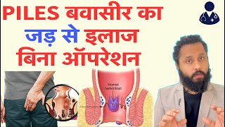 Permanent Treatment of Piles  haemorrhoids treatment Dr Prateek chauha [upl. by Rebecka]