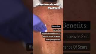 What Is Microdermabrasion  Back Treatment [upl. by Naillimixam484]