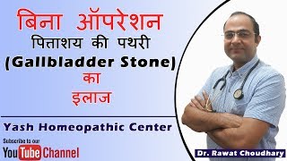 पित्ताशय की पथरी Gallbladder Stone का बिना ऑपरेशन के इलाज  Yash Homeopathic Center [upl. by Ynohtnakram]