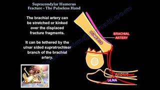 Supracondylar humerus fracture  pulseless hand  Everything You Need To Know  Dr Nabil Ebraheim [upl. by Yared]