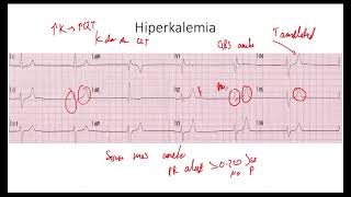 Hiperkalemia EKG [upl. by Benzel255]