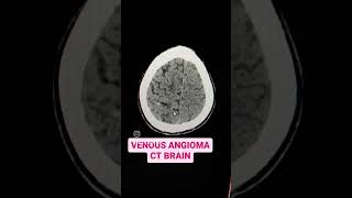 Venous Angioma CT Brain Explained [upl. by Nellahs228]