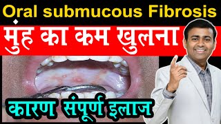 मुंह का कम खुलना कारण संपूर्ण इलाज oral submucous fibrosis I difficult to open mouth hind [upl. by Saltsman]