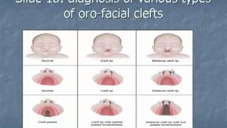 Slide 18 Diagnosis of various types of orofacial clefts [upl. by Euginomod830]