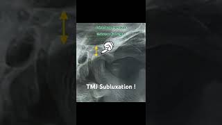 TMJ Subluxation  Radiograph findings  doctor shorts medical surgeon youtubeshorts [upl. by Marissa190]