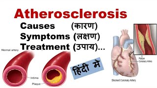 Atherosclerosis  Causes sign and symptoms treatment  Circulatory system disease [upl. by Sowell]