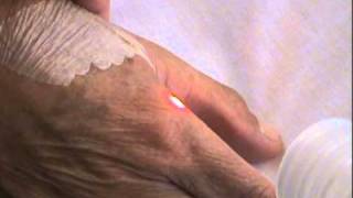 Erbium Laser Facial Neck Declete Hand and Arm Resurfacing [upl. by Larine]