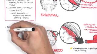 Intracranial Haemorrhage Types signs and symptoms [upl. by Svirad187]