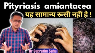 What is pityriasis amiantacea  Treatment  Hindi  Dr Supratim Saha [upl. by Yellah725]