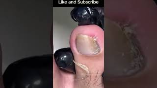 Satisfying Ingrown Toenail Removal in Seconds 👣✨ ingrown [upl. by Witherspoon]