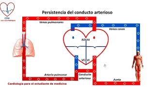 Circuito de la persistencia del conducto arterioso [upl. by Onifur]