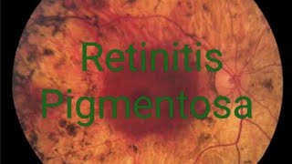 Retinitis pigmentosa RP treatment signs symptoms discussion  Simple version [upl. by Flinn]