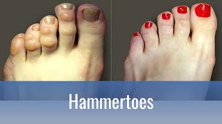 Hammertoes Why do they hurt and how to fix them [upl. by Aiyram140]